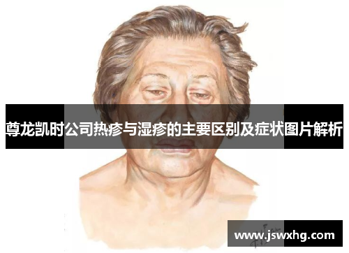 尊龙凯时公司热疹与湿疹的主要区别及症状图片解析
